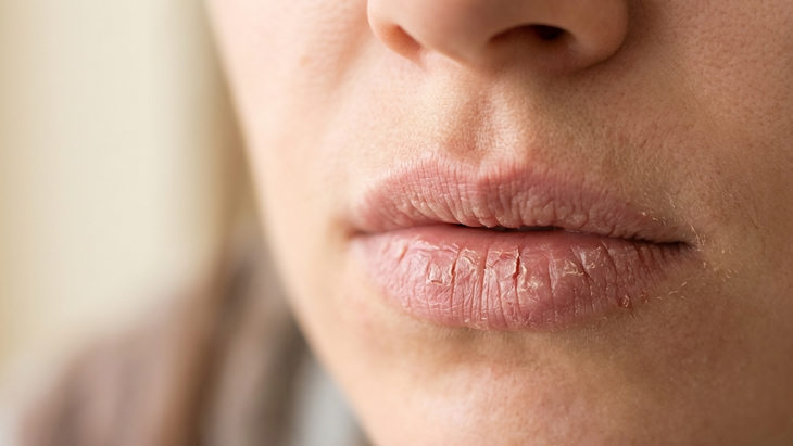 Jangan Dianggap Sepele, Bibir Kering Bisa Jadi Tanda Tubuh Kekurangan Cairan hingga Gejala Penyakit