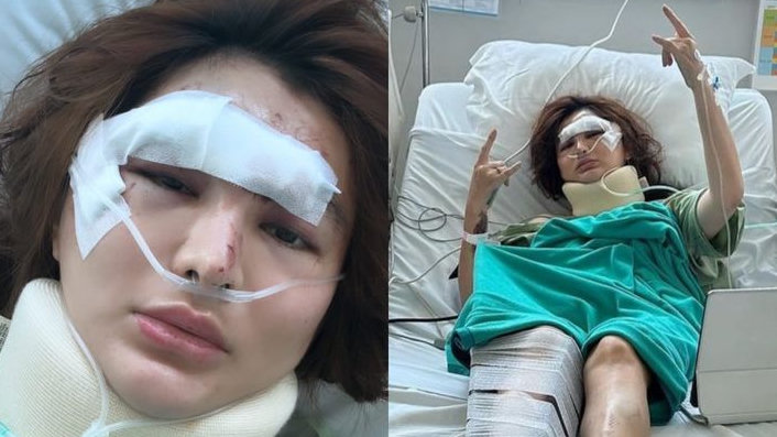 Angela Lee Alami Kecelakaan Mobil, Luka-luka Parah, Kakinya Dipasang Pen, Ini Kronologisnya